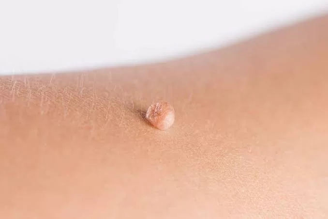الدراسات و التجارب تدل على أن أسباب ظهور الزوائد الجلدية